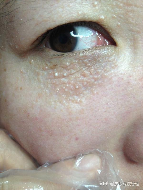 如何彻底祛除汗管瘤? 知乎 如何彻底祛除汗管瘤? 知乎