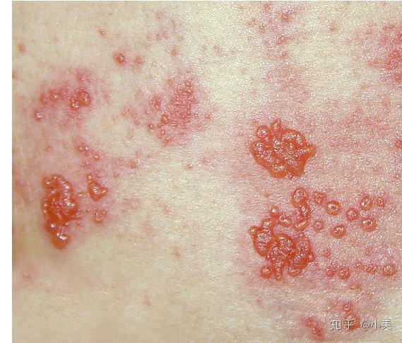 可怕的春季过敏