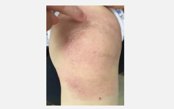 周女士的宝宝萌萌,1岁女婴,满2个月的时候面部发过大片红疹,去医院