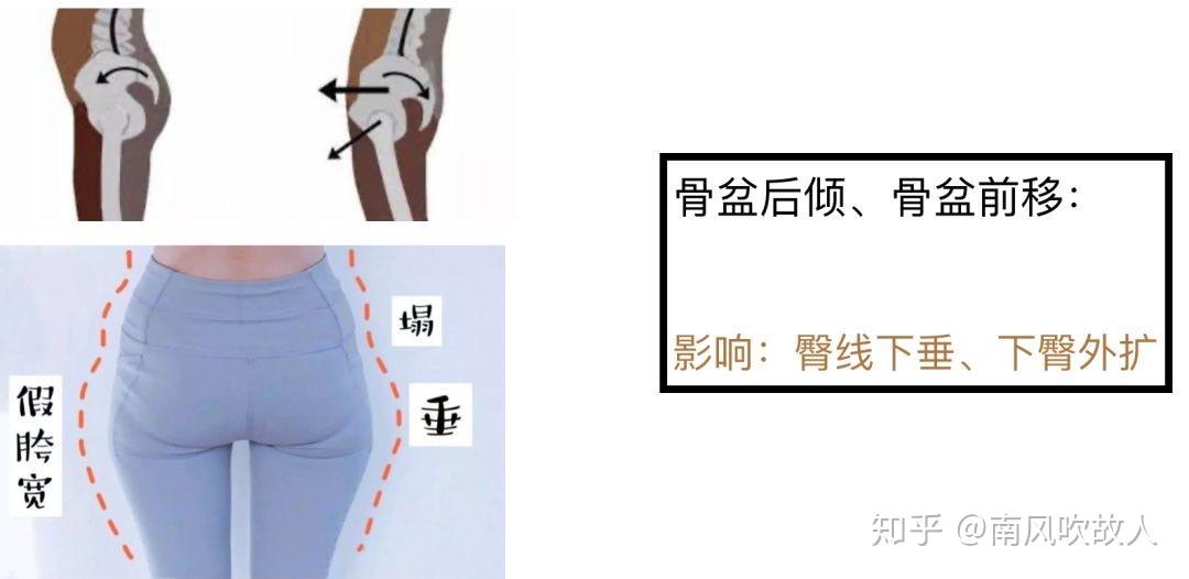 告别假胯宽快速改善骨盆宽大