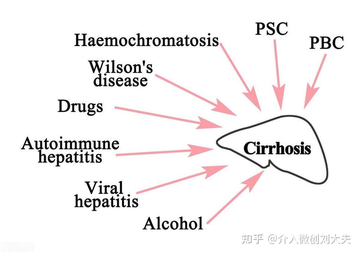 肝硬化食管胃静脉曲张破裂出血该如何选择手术:TIPS分流 OR 外科断流? - 知乎
