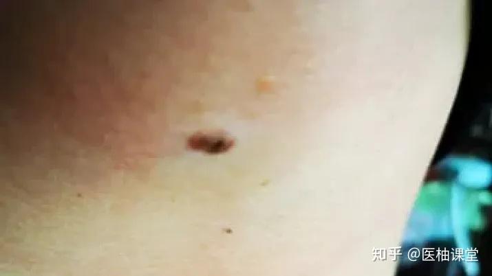 黑痣癌变， 从发病到去世不到两个月！这些痣千万要小心！ - 知乎