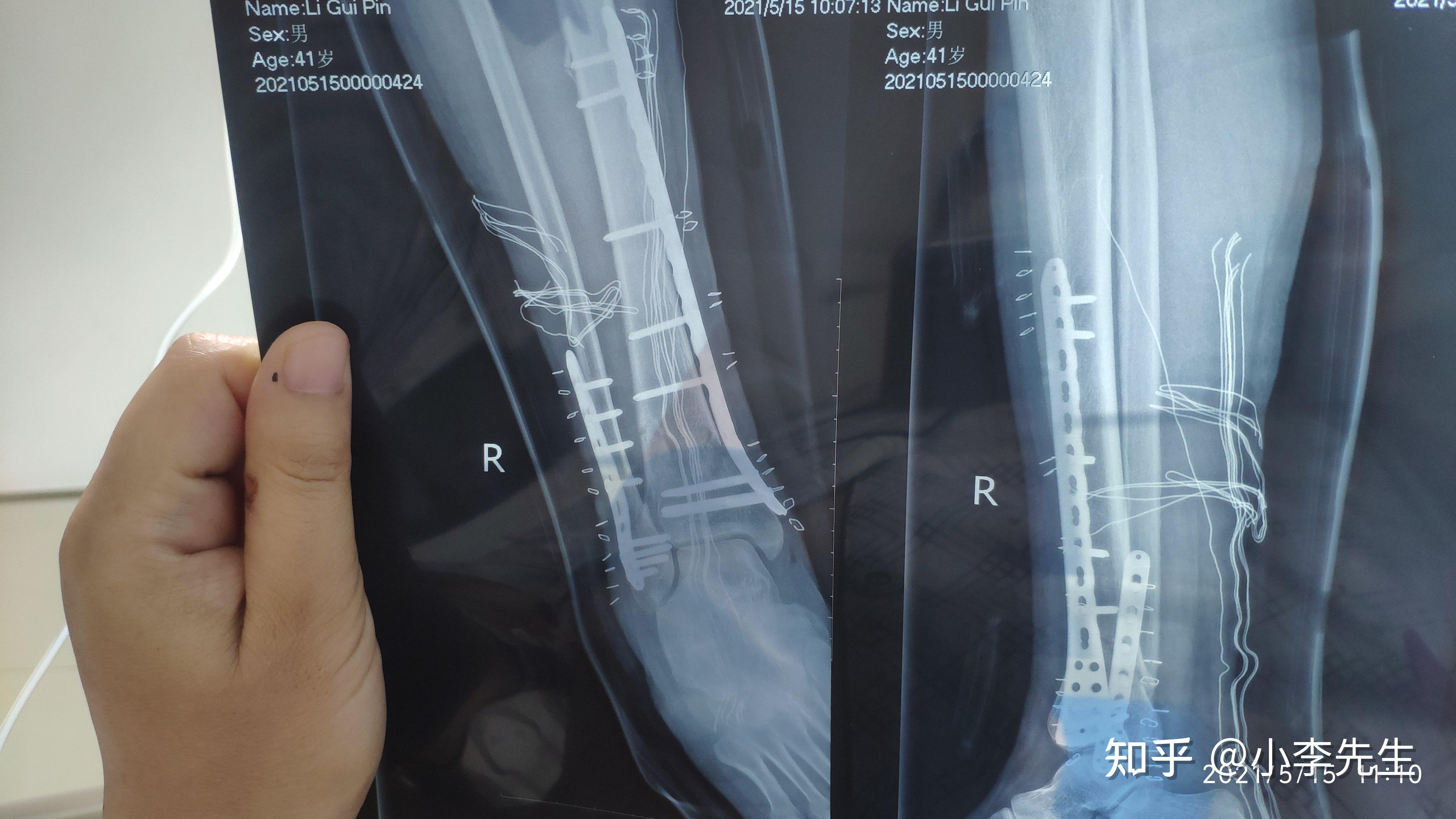 記錄下自己脛腓骨骨折治療康復過程