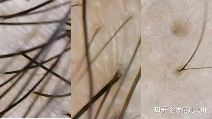 3109字干货讲清：植发的危害和后遗症、植发医生不会说的问题、不适合植发的人群特征... - 知乎