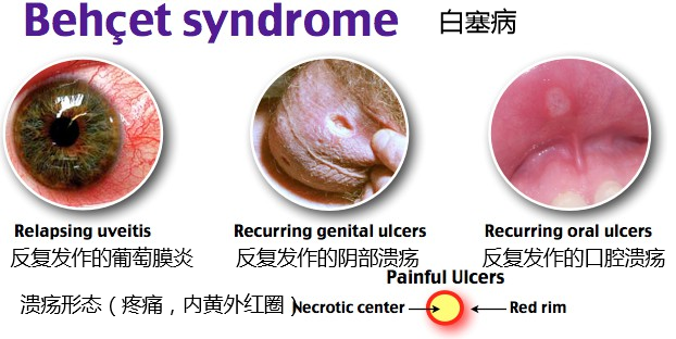 反复口腔溃疡警惕