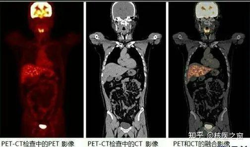 【解惑】PET/CT检查报告里的SUV值是什么？ - 知乎