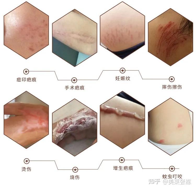 厦门疤痕修复|疤痕和瘢痕有什么区别? - 知乎
