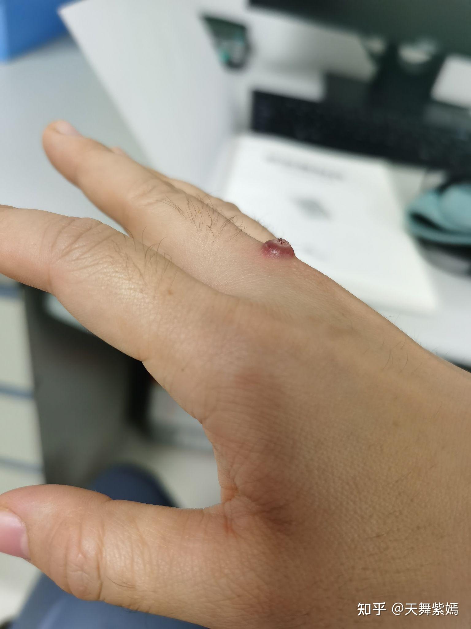 记录我的瘊子冷冻到脱落过程