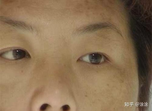 斑的种类有哪些