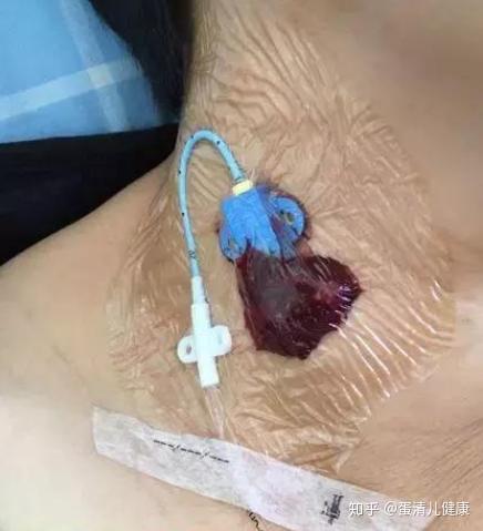 picc导管穿刺点出血后如何护理?