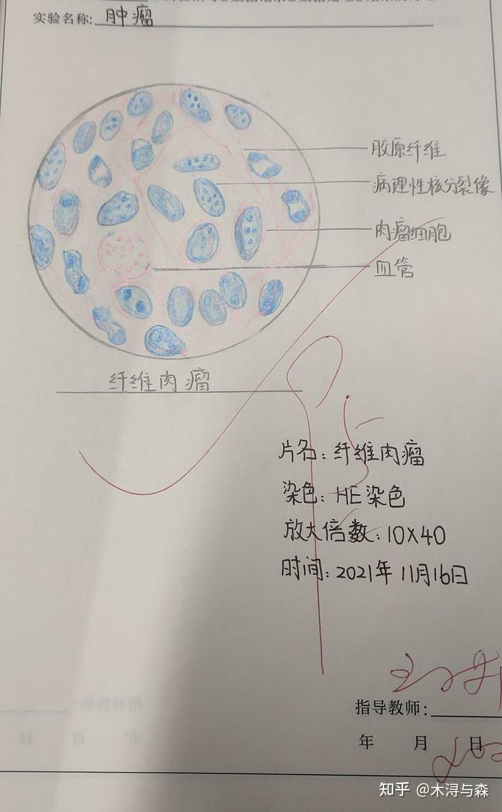 病理骨肉瘤红蓝手绘图片