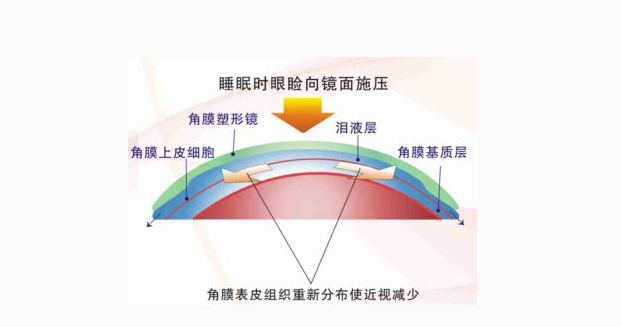 crt角膜塑形镜排名图片