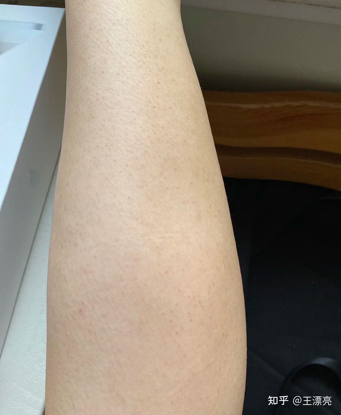 包含鸡皮肤要不要擦身体乳的词条