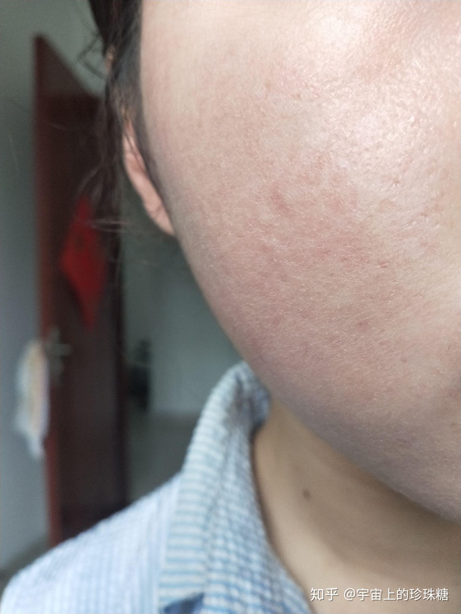 刷他扎罗汀20天