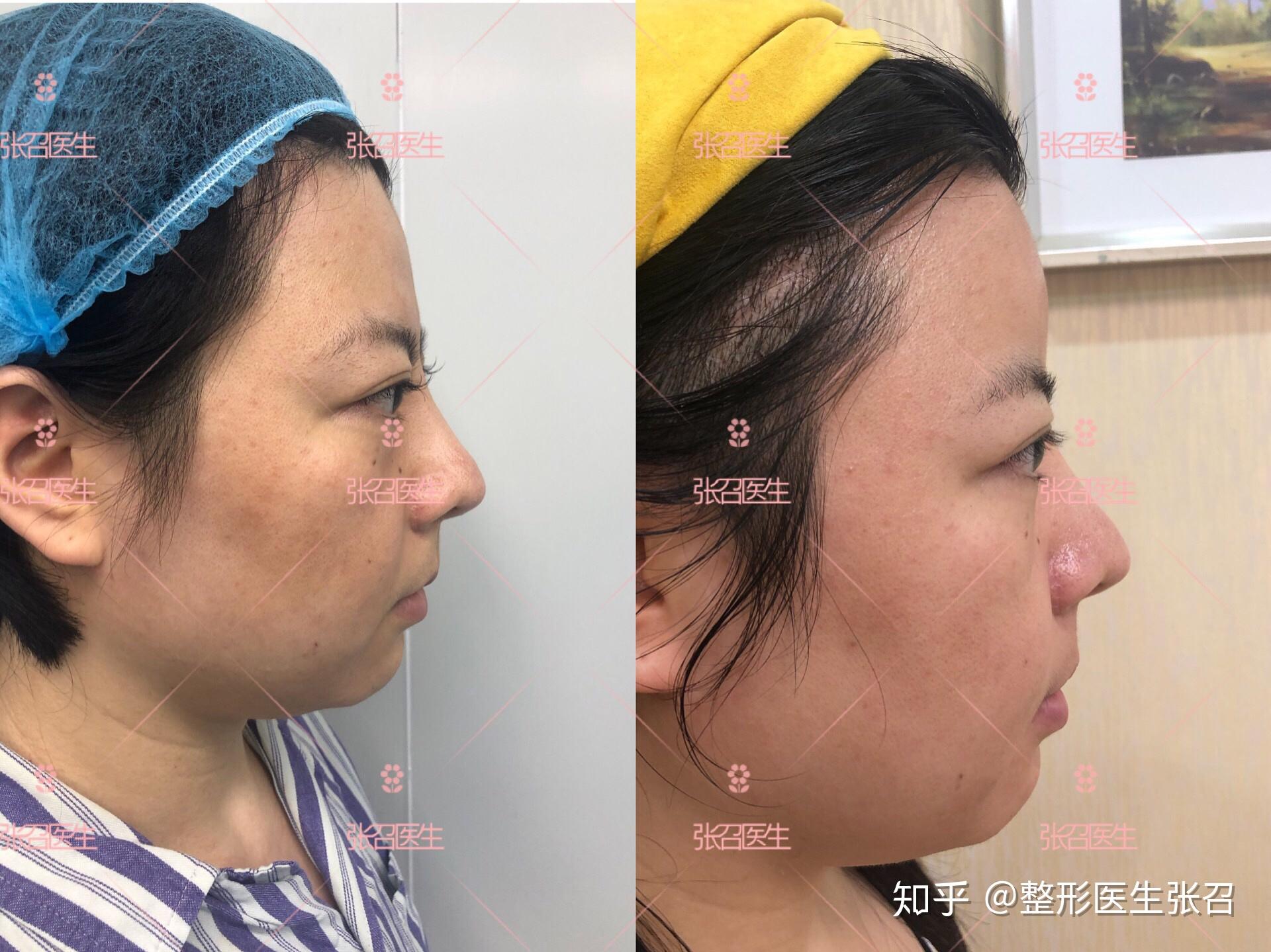 假体丰额头会有坎吗?