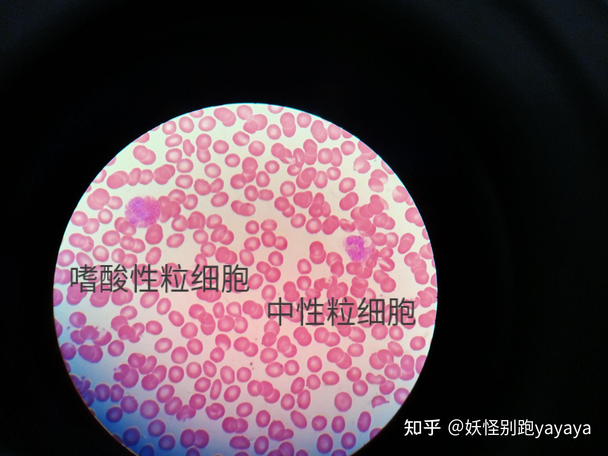 大便镜检吞噬细胞图片,镜检白细胞,粪便中的吞噬细胞图片_大山谷图库