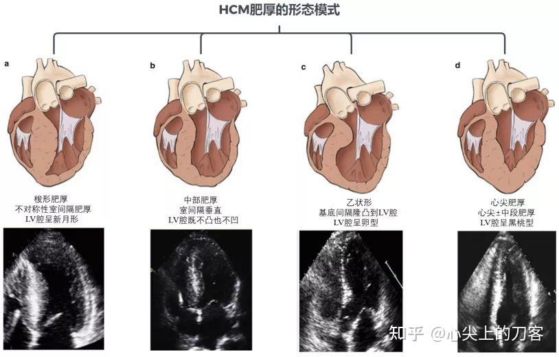 肥厚性心肌病