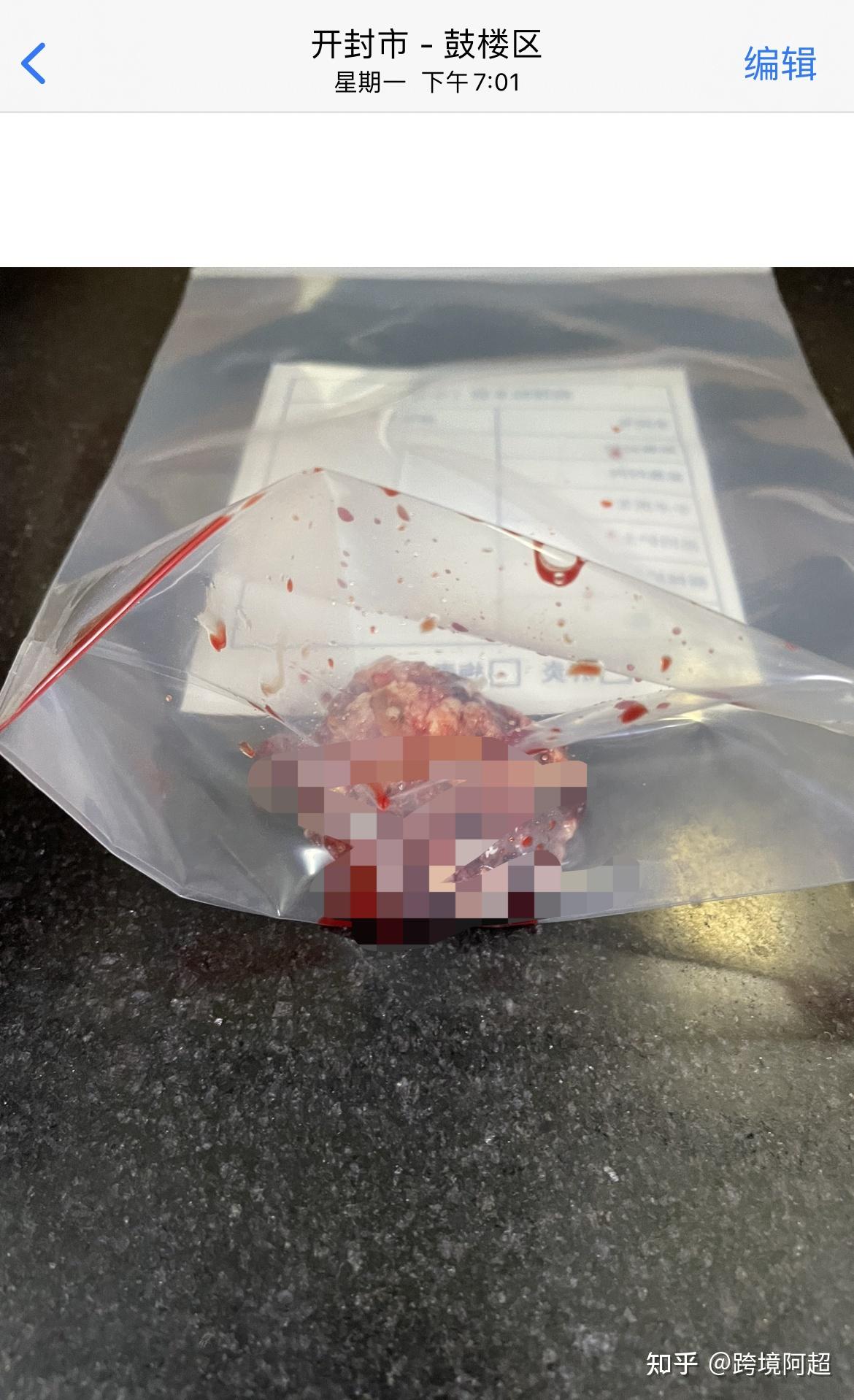恶性脑胶质瘤有多可怕放化疗是为了治疗还是续命