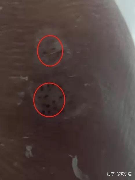 我想确认一下,我这个是血胞刺,还是趾疣 - 知乎