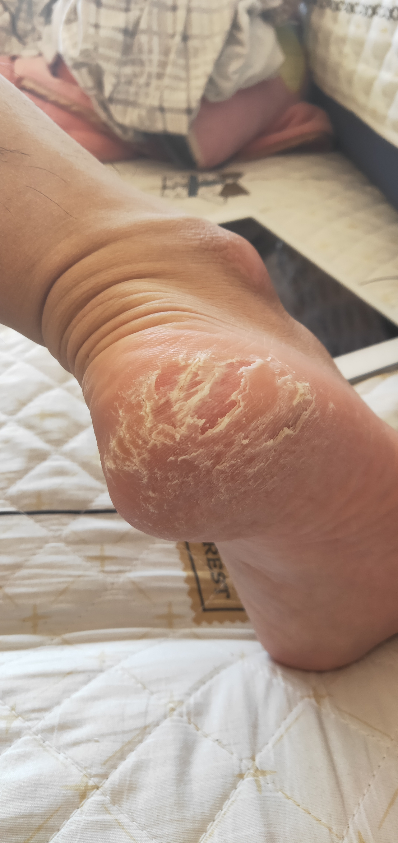 脚后跟开裂用什么药膏好呢