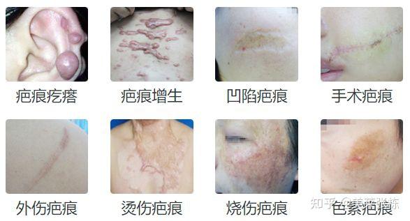 厦门疤痕修复|凹陷疤痕分为哪几种?如何有效修复凹陷性疤痕? - 知乎