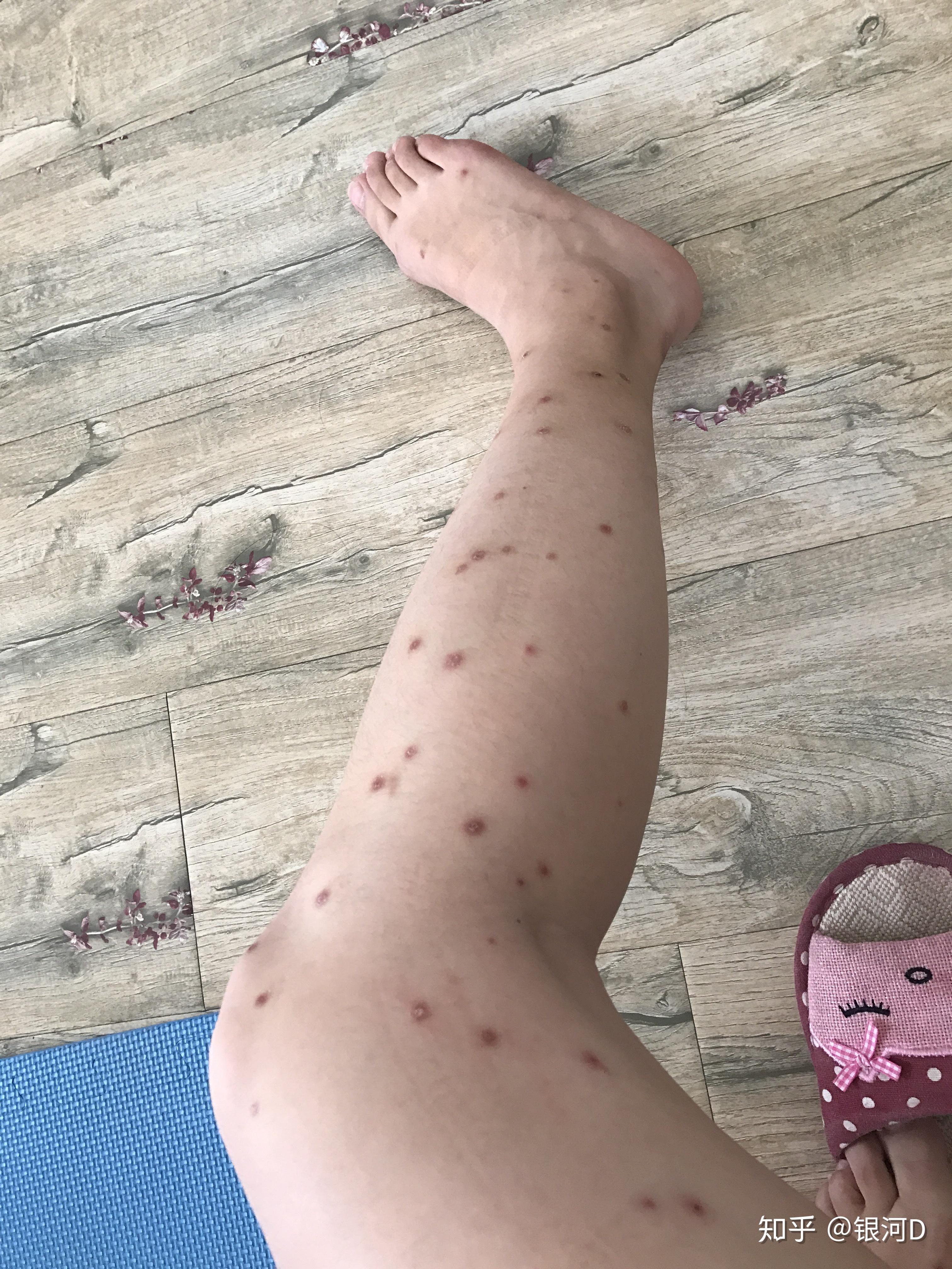 我治好了自己的结节性痒疹 - 知乎