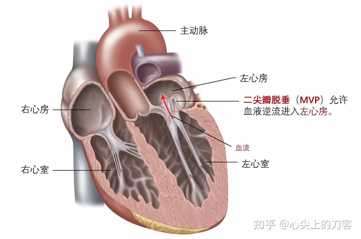 二尖瓣前叶后叶图片