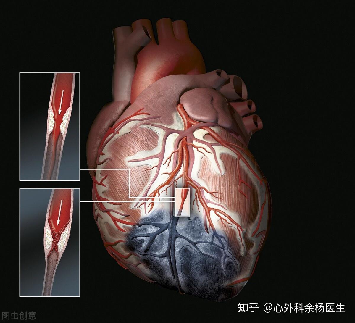 心臟搭橋與起搏器有什麼區別會影響壽命嗎