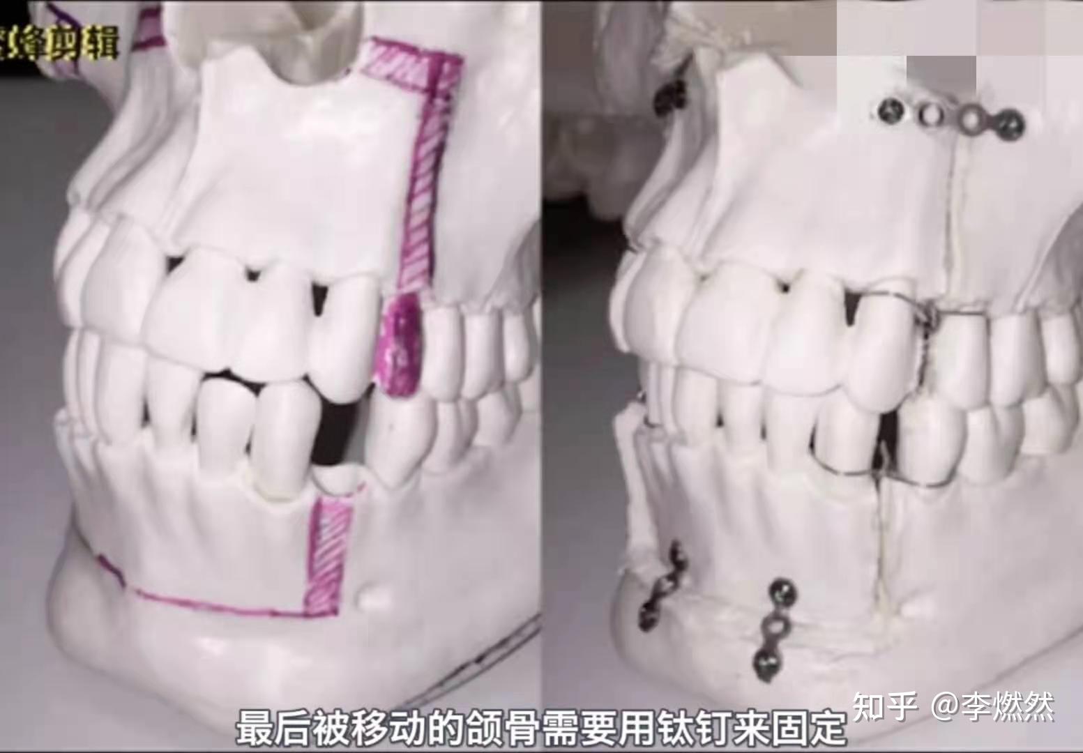 凸嘴正颌手术安不安全效果怎么样要多少钱
