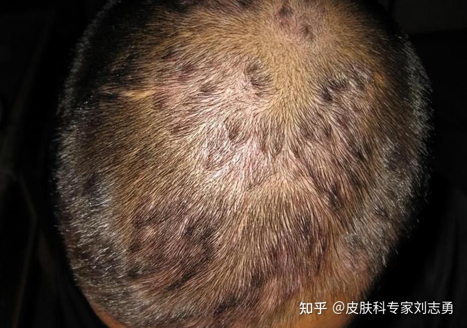 为什么头皮上总长红疙瘩和脓包?是什么引起的?不是小事,得当心 - 知乎