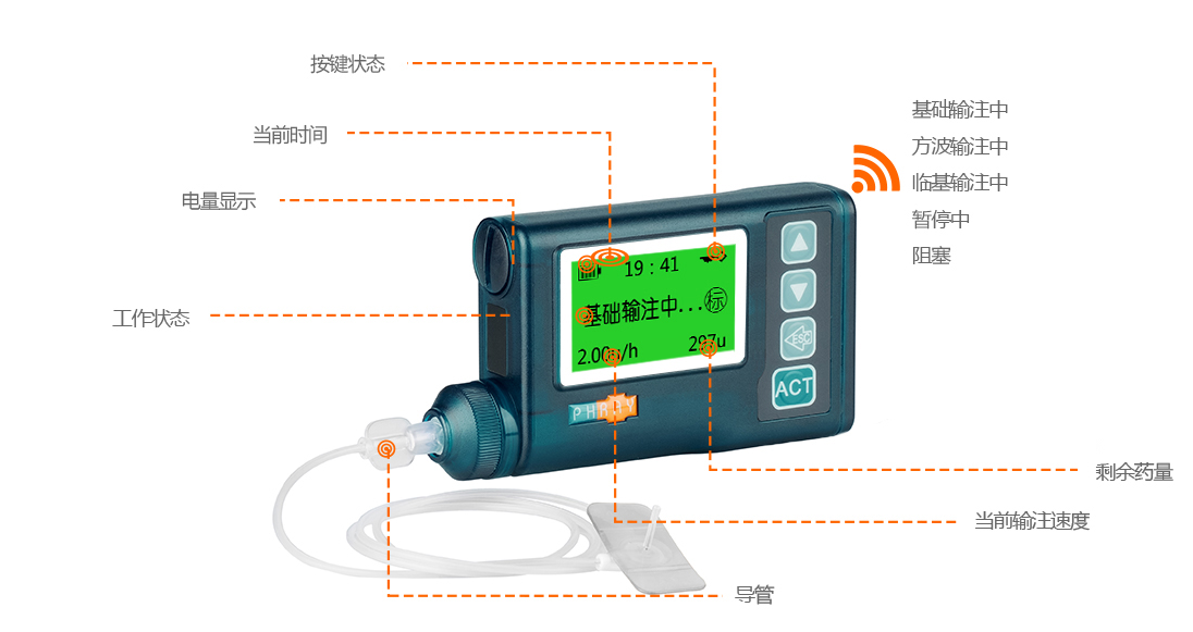 胰岛素泵初发在2型糖友中起到什么作用