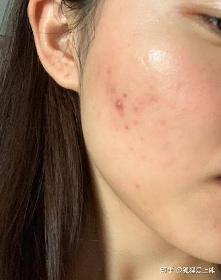 痘痘肌怎么办呀熬夜长痘姨妈长痘针清没用中药没用反反复复有没有同感