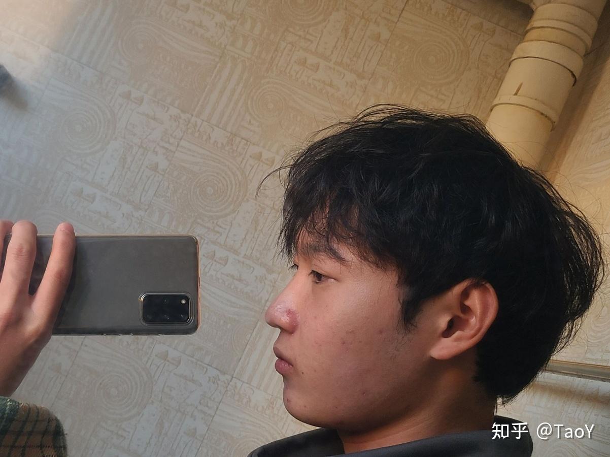 鼻子上凸起的增生痘疤怎么去除