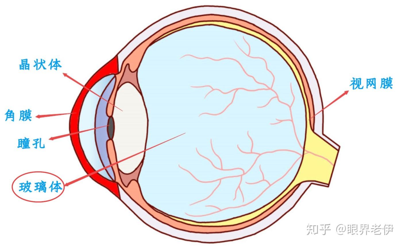 玻璃体液化怎么办