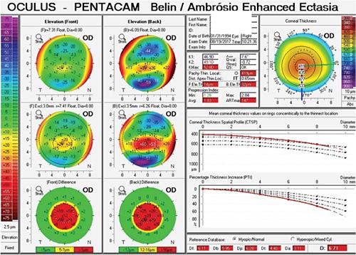 为什么超声角膜测厚检查怎么看角膜地形图呢？？_https://www.jmylbn.com_新闻资讯_第13张