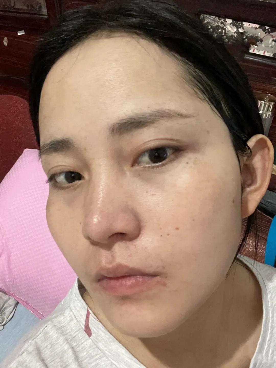 如何除脸上的黄褐斑