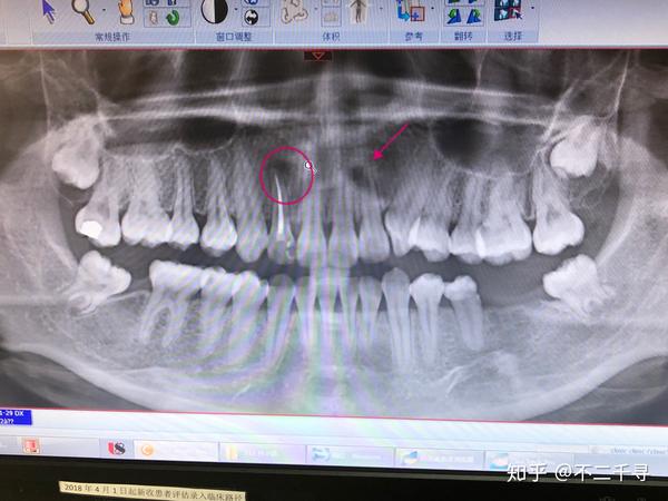 記錄牙齒智齒牽引正畸種植治療