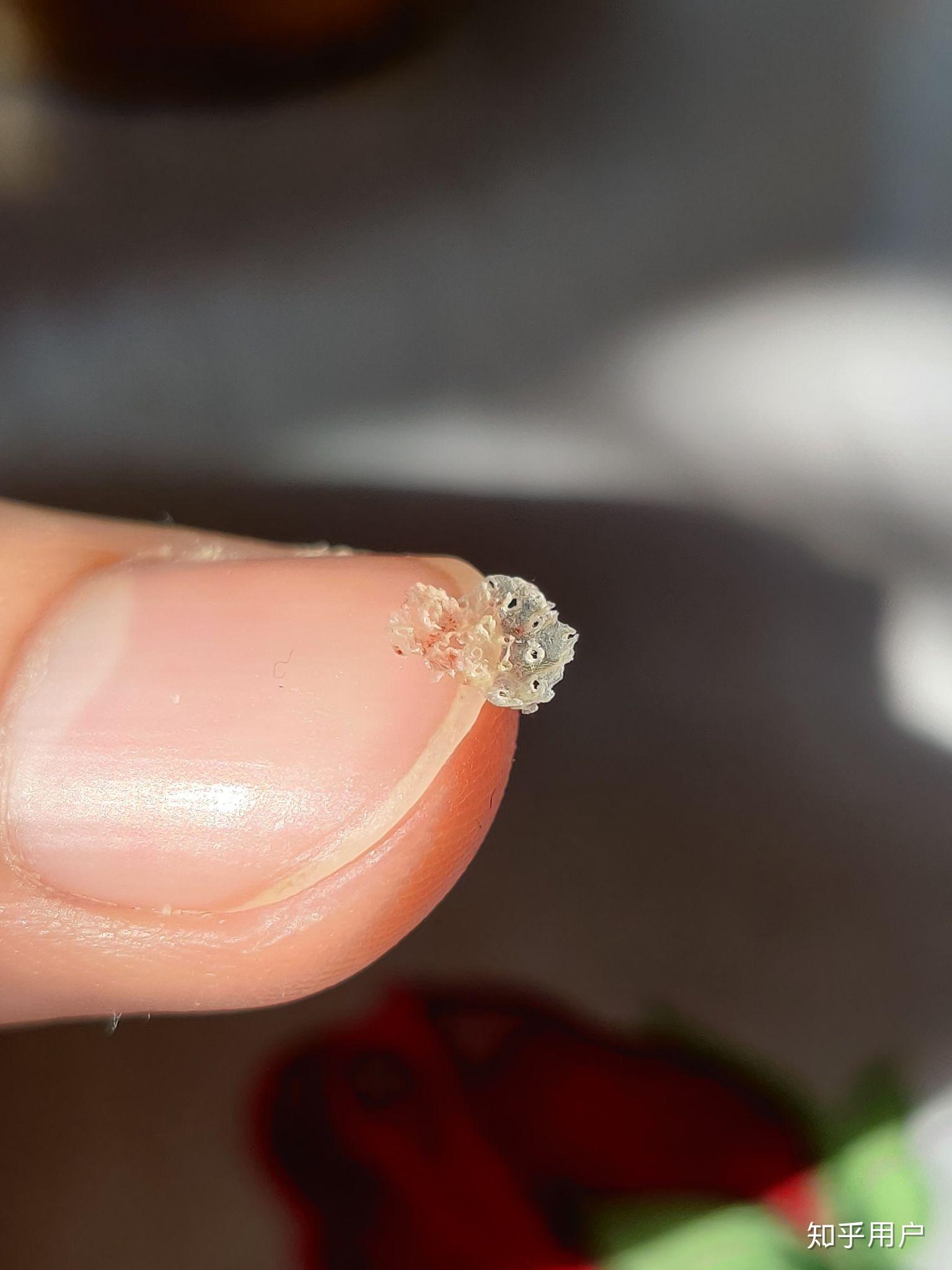 见过的最大头皮屑多大