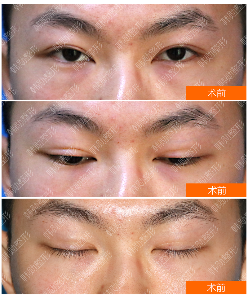 韩勋双眼皮修复无力大小眼的改变