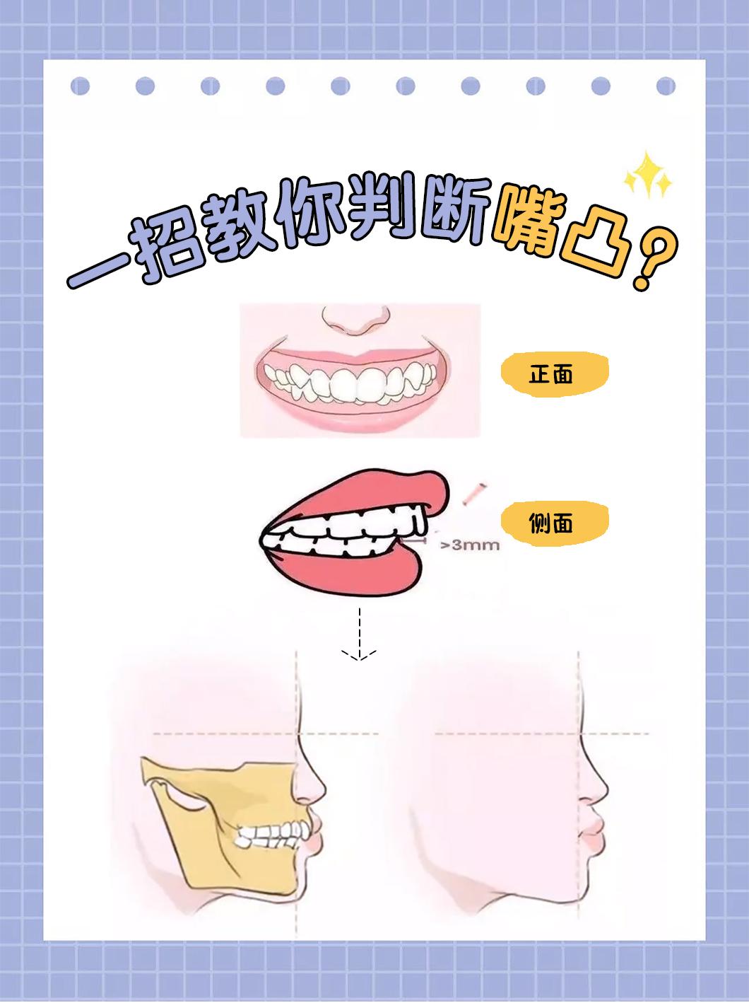 戴牙套可以改善牙齿外凸的程度是多大？（有图） - 知乎