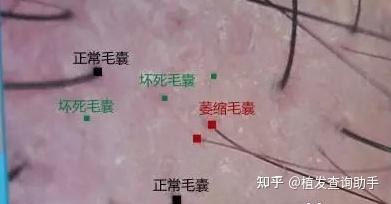 额角发际线秃,想做植发,在不剃发植发和微针植发中纠结,有大佬给建议吗? - 知乎