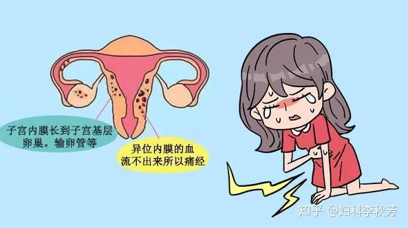 肚子总是隐隐作痛 千万别忽视 警惕这4种妇科病 知乎