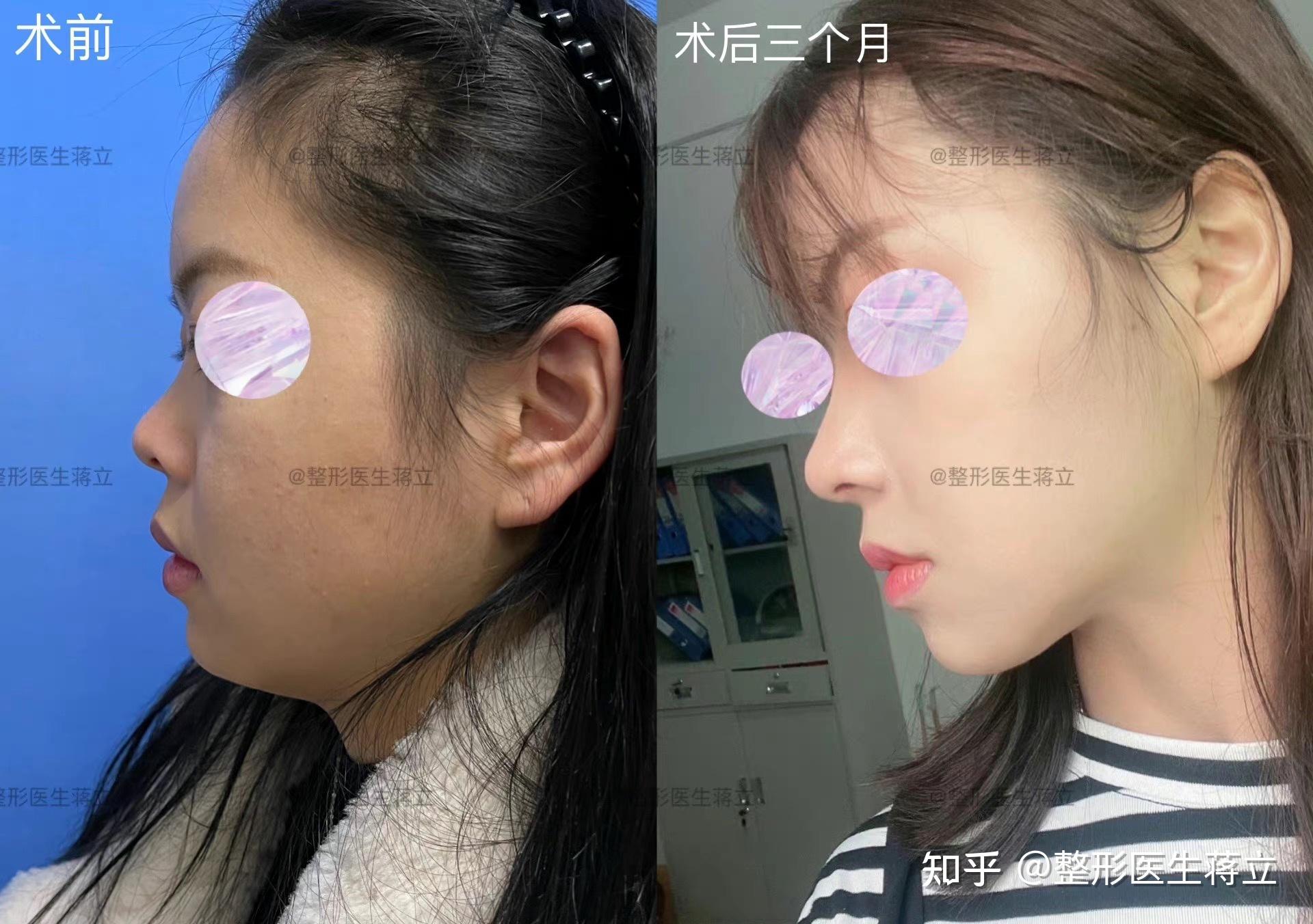 【半肋+膨体】短鼻,塌鼻,鼻翼外扩,嘴巴前凸,面中不立体,鼻基底凹陷,鼻翼缘退缩露鼻孔,歪鼻,鼻翼不对称,鼻翼沟起点不同(术前术后即刻,术后三 ...