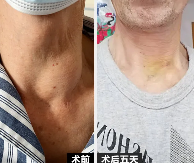 得了甲狀腺結節只能手術開刀治療嗎