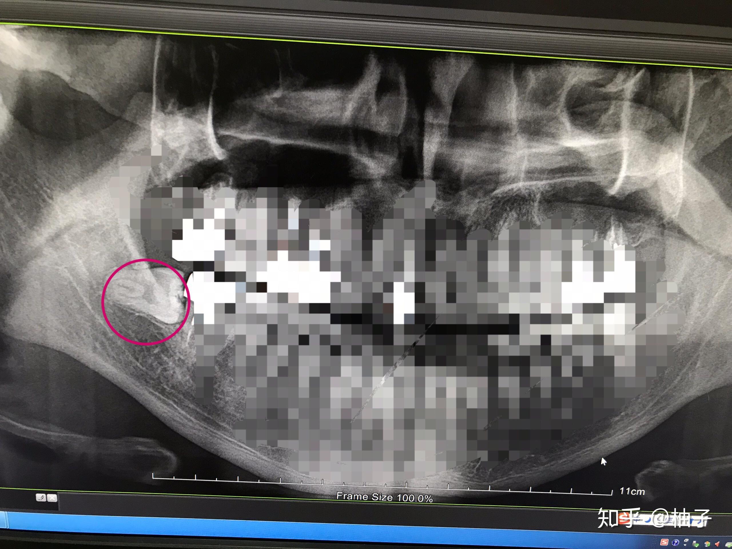 右侧下颌阻生智齿拔除及术后恢复记录