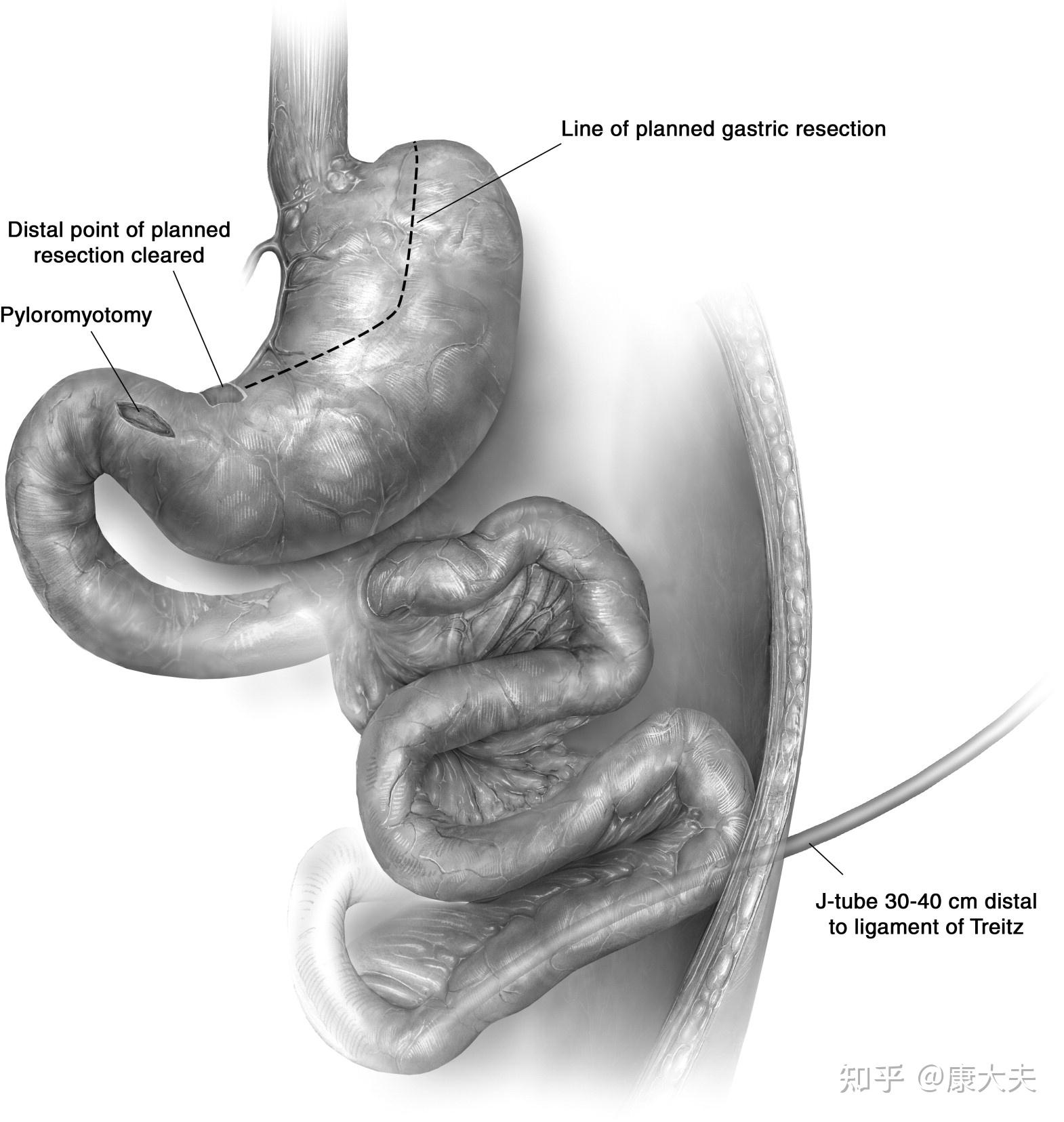 食管空肠吻合术图片
