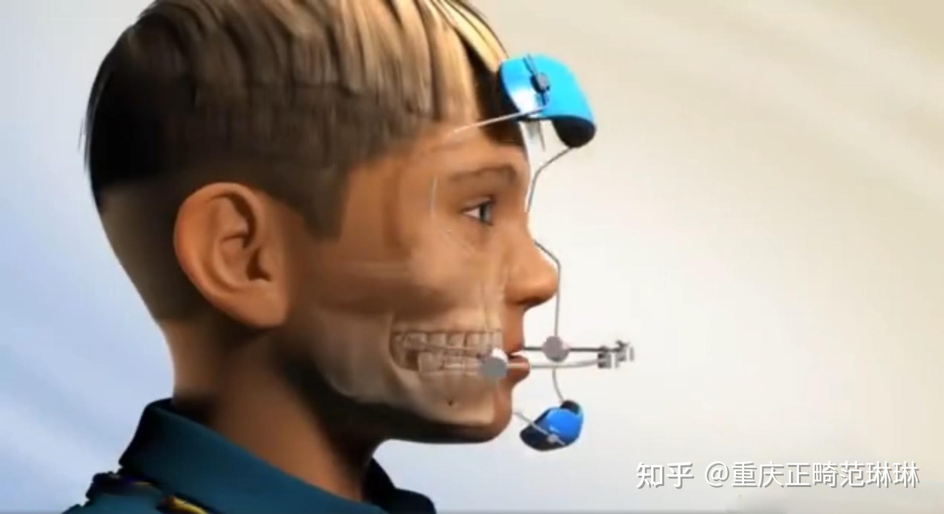 重庆牙齿矫正地包天矫正后月牙脸变精致侧脸