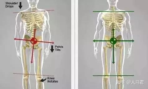 骨盆后倾和骨盆高低不平