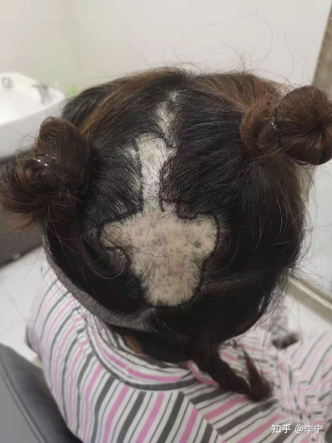头上有疤的地方可以植发吗