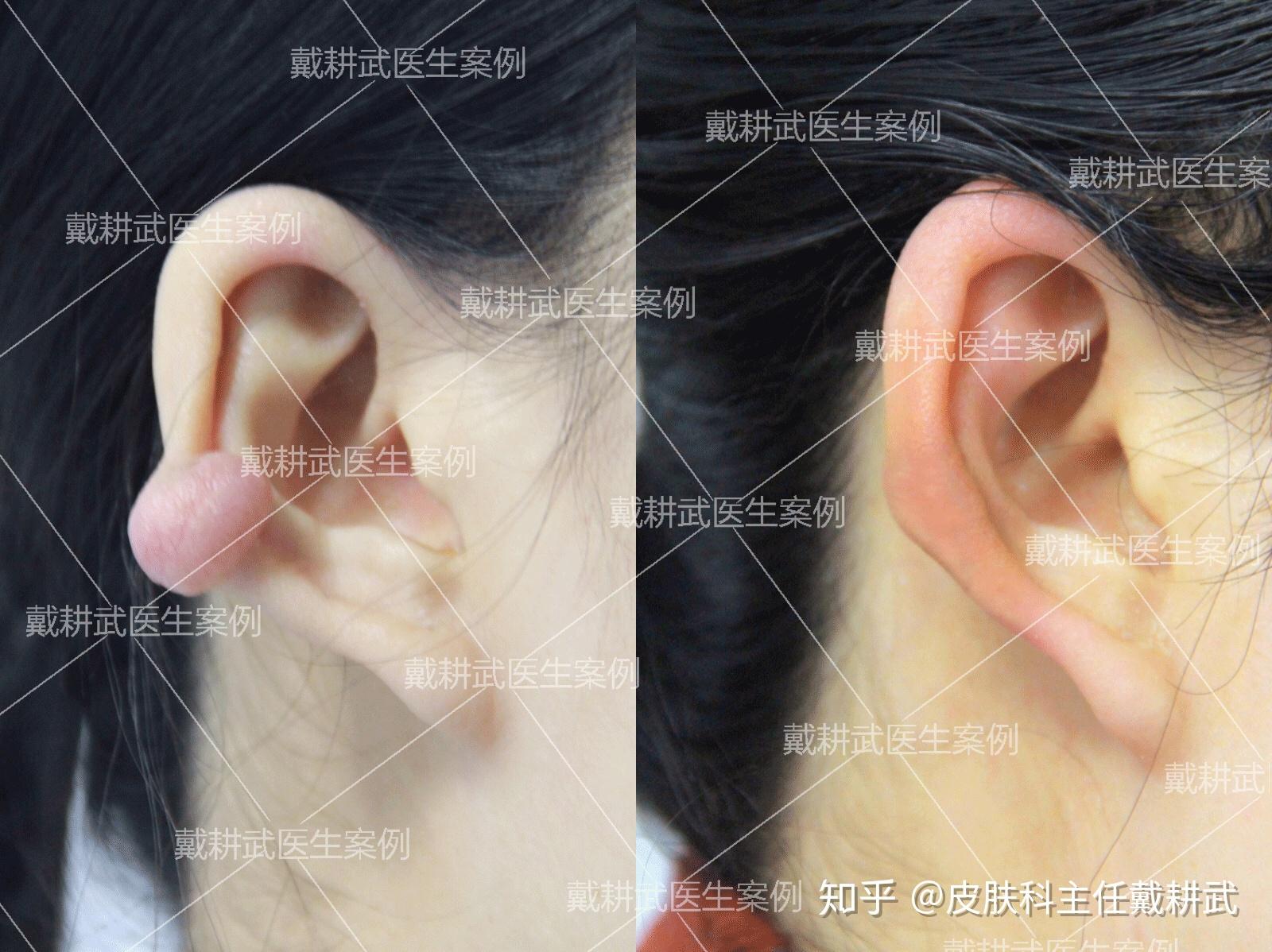 耳朵瘢痕疙瘩治疗方法 - 知乎